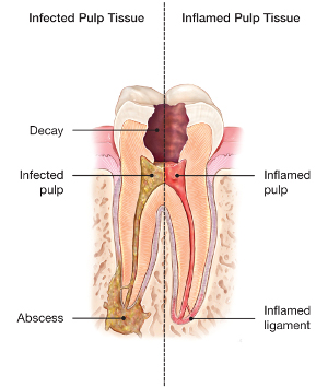 abscessed-tooth