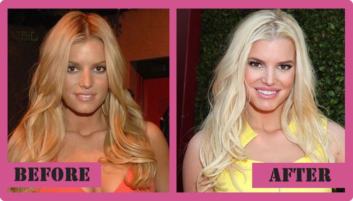 jessica-simpson-plastic-surgery-before-and-after