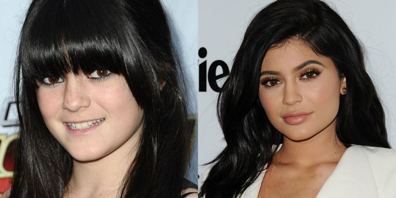 kylie20jenner20plastic20surgery20collage