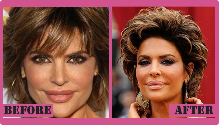 lisa-rinna-plastic-surgery-before-and-after